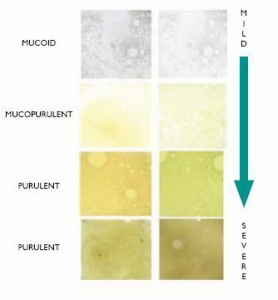 Sputum Pathology - Bronchiectasis