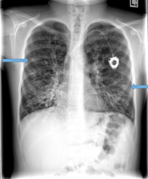 bronchiectasis x ray tram track