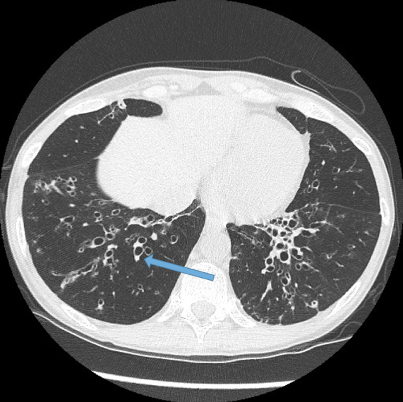 Bronchiectasis X Ray Tram Track