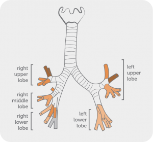 Lung anatomy - Bronchiectasis